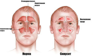 В чем разница между синуситом и гайморитом