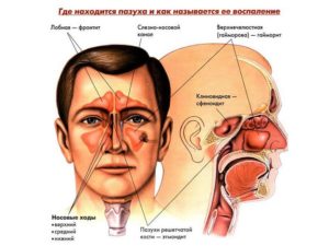 В чем разница между синуситом и гайморитом