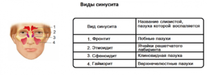 В чем разница между синуситом и гайморитом