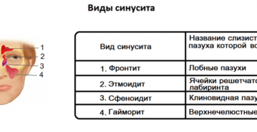 В чем разница между синуситом и гайморитом